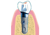 Schnittansicht: Implantatkörper aus Titan mit Krone, rosa Zahnfleisch und gelbbraunem Kieferknochen.
